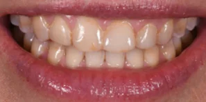 The Complete Guide to Dental Implants