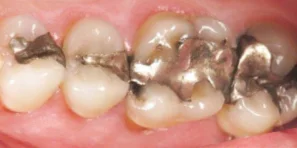 Is Invisalign Right for You?