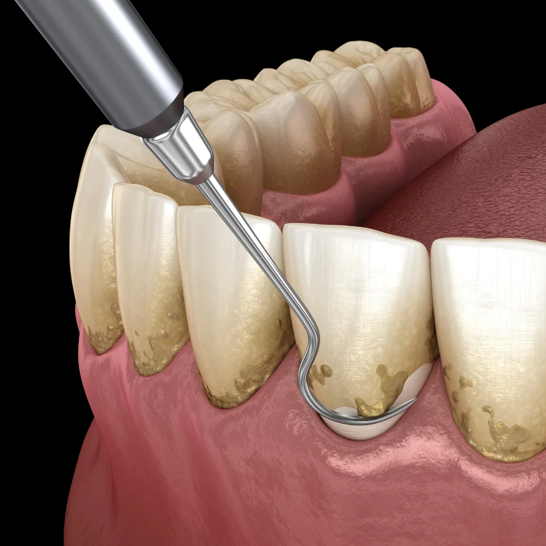 Deep cleaning and scaling procedure at Glendale Dental Wellness