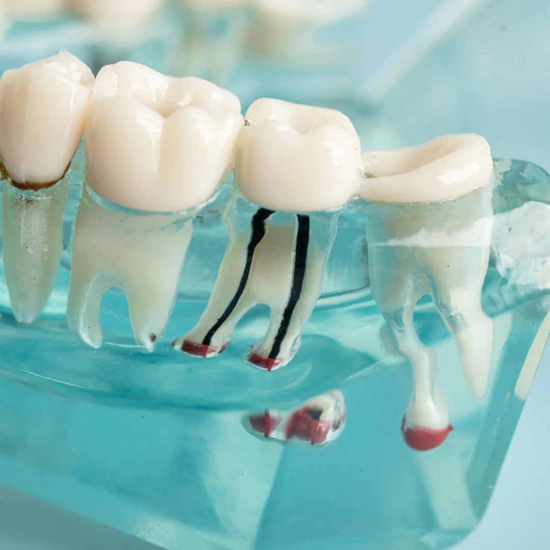 Root Canal Therapy