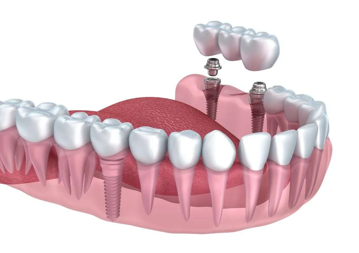 5 Myths About Dental Implants Debunked in Glendale, CA
