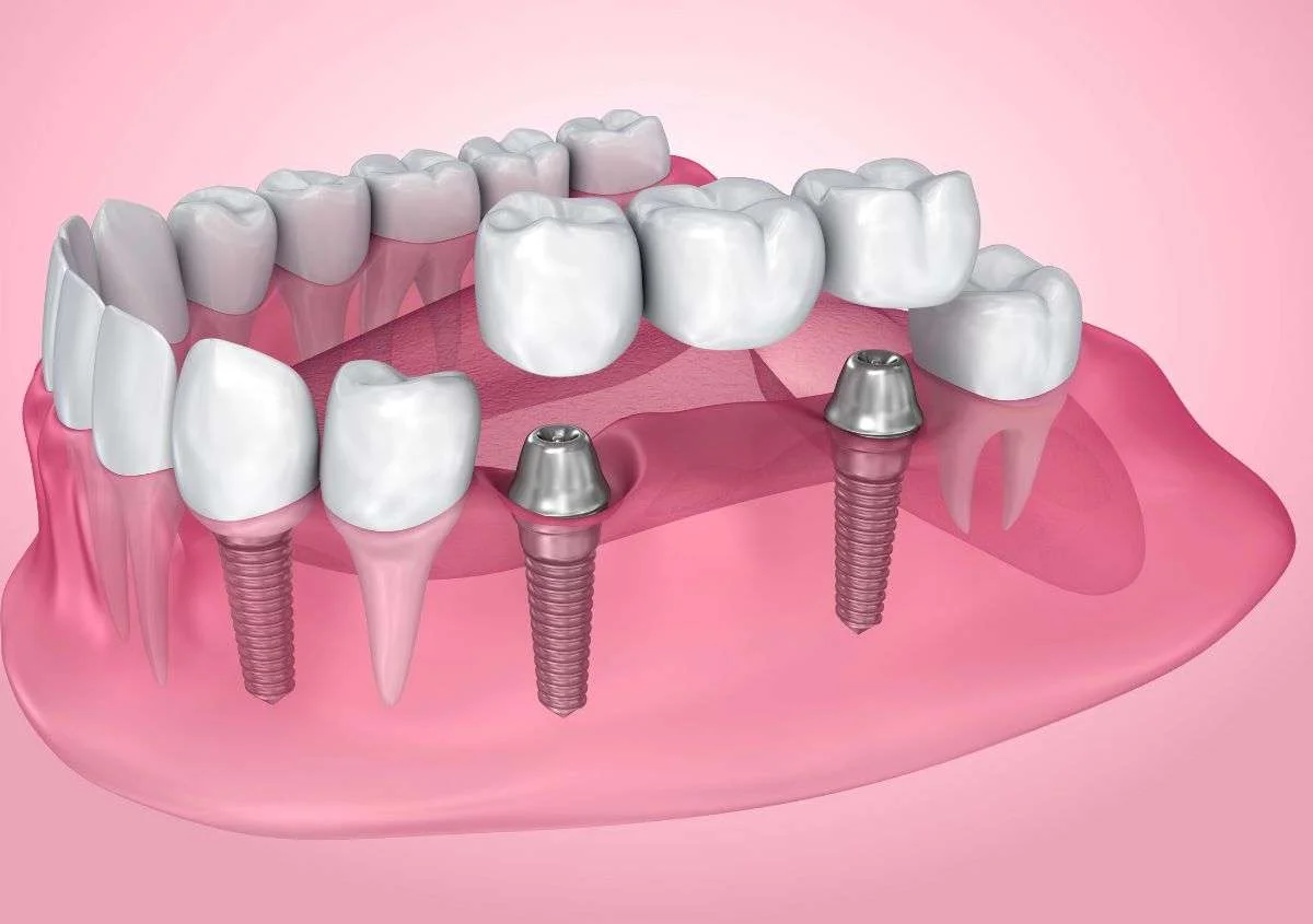 How Your Dentist Addresses Safety Concerns Surrounding Dental Implants