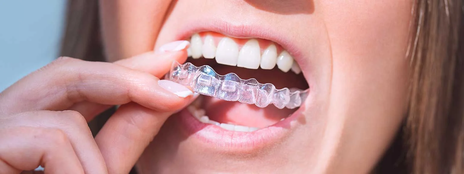 The Next Steps After Invisalign: 5 Essential Actions for Long-Term Success