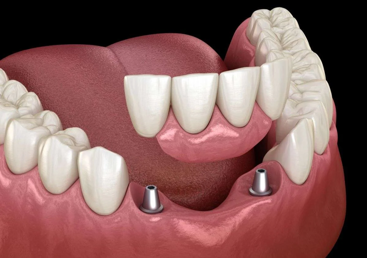 5 Steps You Can Take to Ensure Your Porcelain Crown Lasts