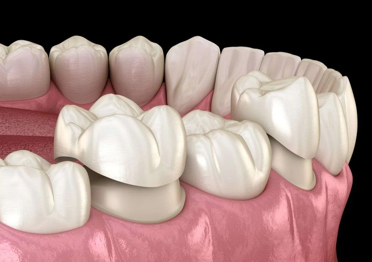 5 Signs You May Need Porcelain Crowns for Your Front Teeth in Glendale, CA