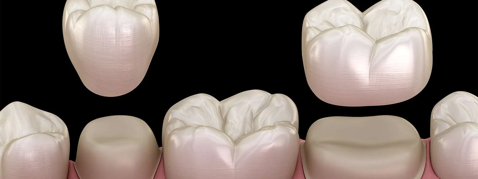 Reasons a Dental Crown May Be Used on Front Teeth