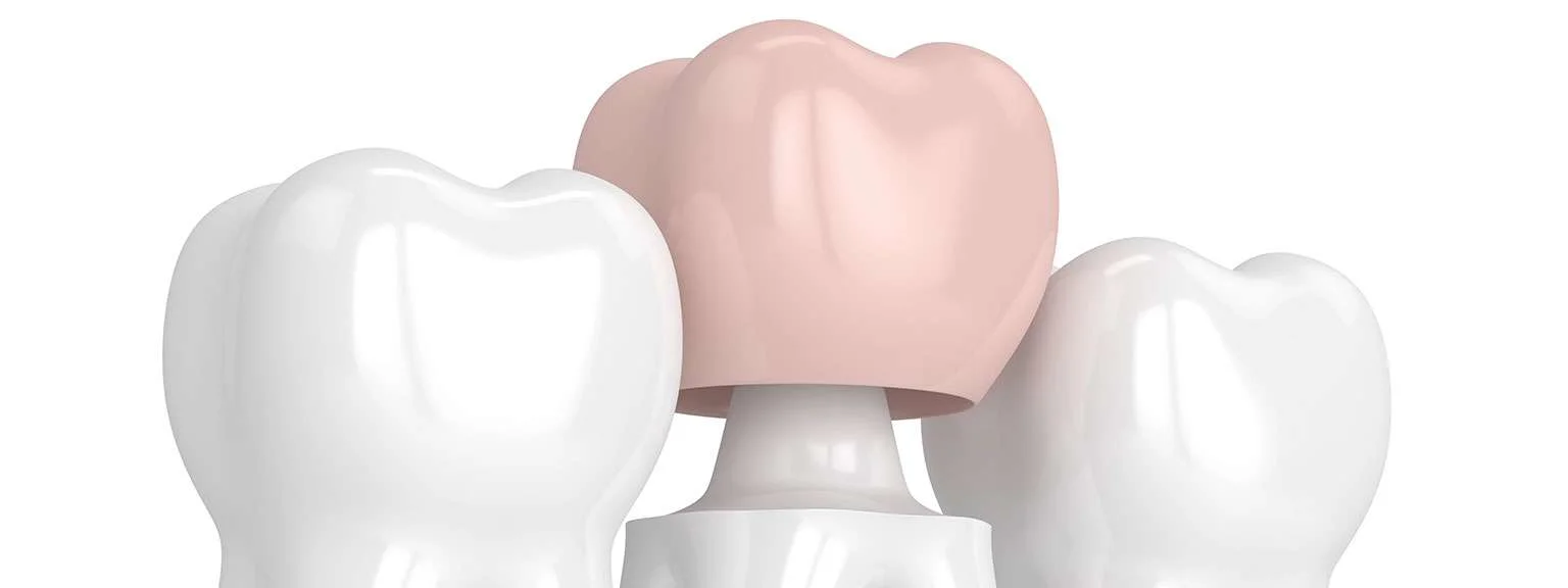 How Does CAD/CAM Technology Allow For Same Day Dental Crowns?