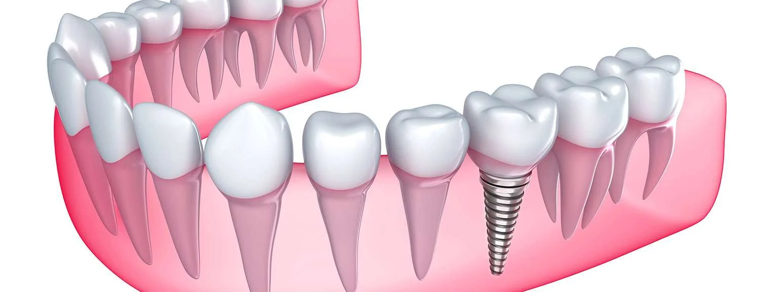 Single Tooth Implants: Understanding the Process
