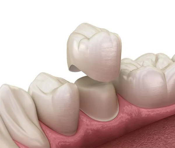 Same-Day Crowns (CAD/CAM)