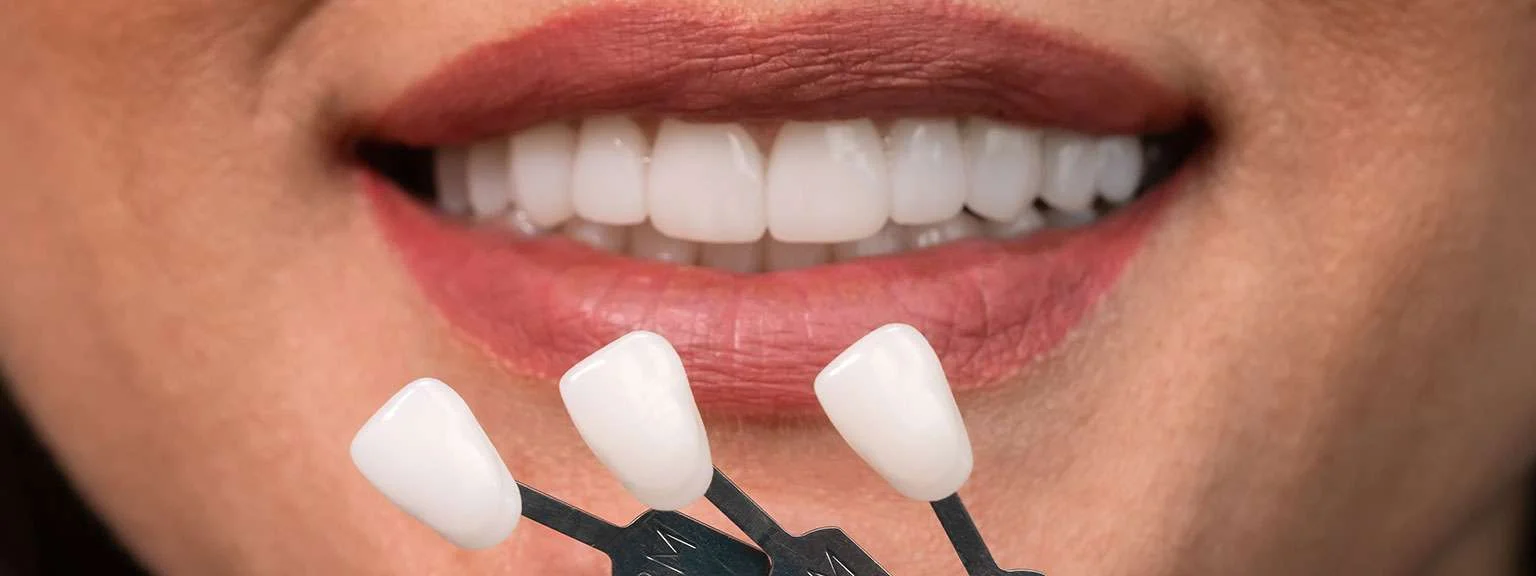 Patients Ask Local Dentists About Veneers and How They Are Placed On Teeth