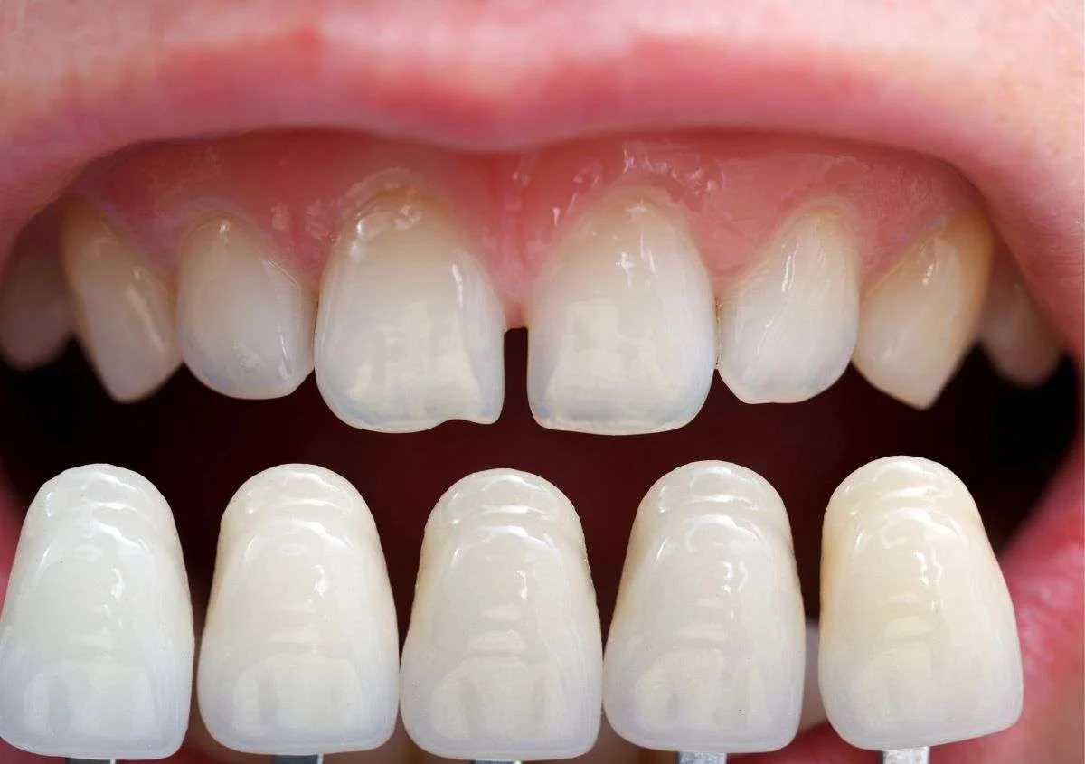 Top 5 Reasons Patients Choose Veneers as Summer 2025 Approaches