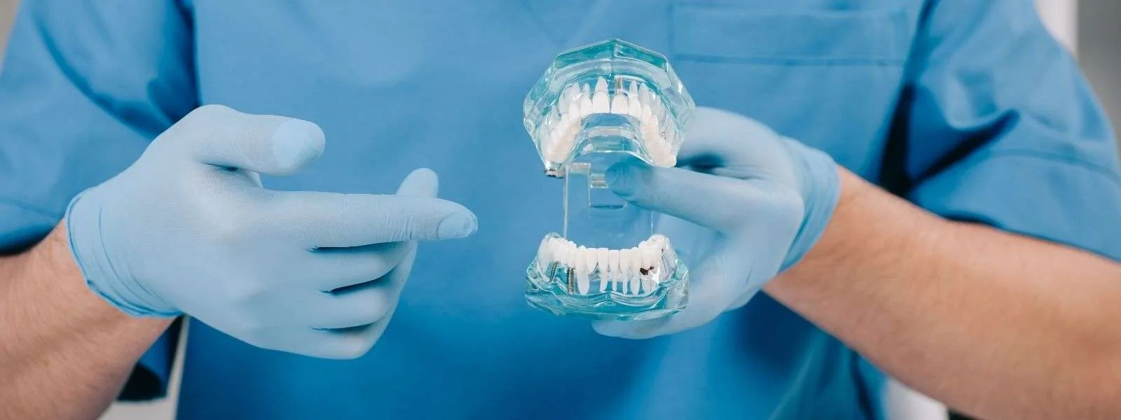 Dental model showing implants placed in both the upper and lower arch for full mouth dental implant treatment in Glendale, CA
